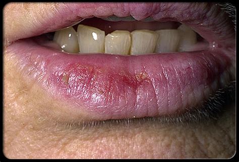 Actinic Keratosis Lip