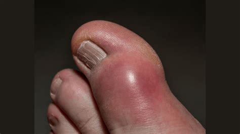 9 Pictures of the Gout: Symptoms, Food to avoid, other tips : Physiosunit