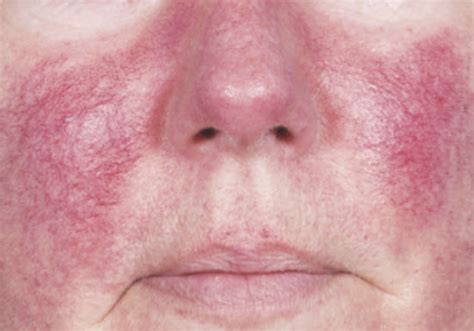 Everything You Need To Know About Rosacea And How To Treat It - Lauren Erro