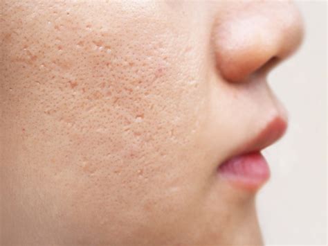 Types of Acne Scars & How to Treat Them