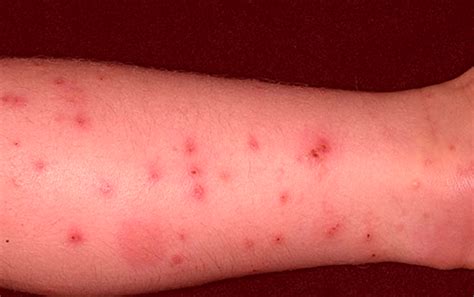 Flea Bites on Humans – Symptoms, Treatment, Pictures | hubpages