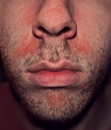 Seborrheic Dermatitis and Rosacea | Rosacea.org