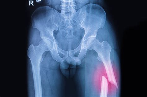 Fractured Femur Broken Thigh Xrays Image Stock Photo - Download Image Now - iStock