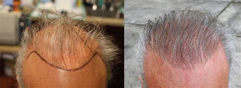 Hair Transplant Repair with Beard & Chest Hair | Orange County, CA