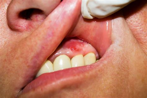 3 Signs of an Abscessed Tooth | General Dentistry Houston