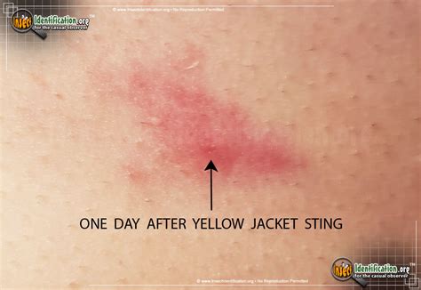 Yellow Jacket Stinger