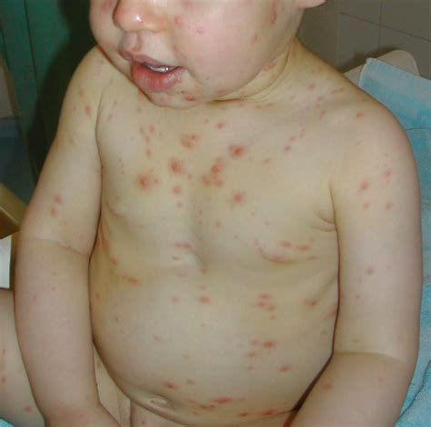 Varicella | Chickenpox (varicella zoster virus) lesions on a… | Flickr