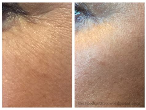 Real Before-and-After Photos - E Experiments: SkinMedica's HA5 ...