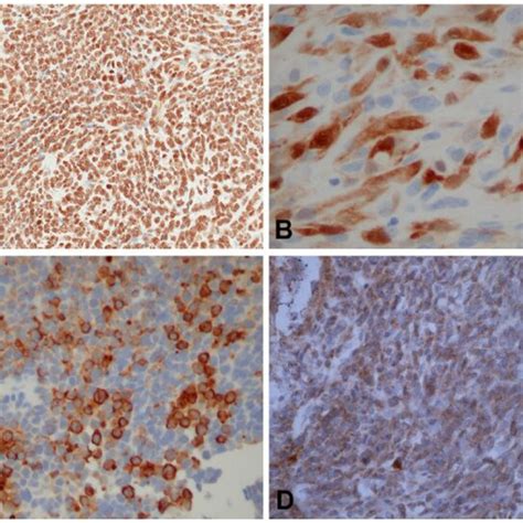 Immunohistochemical staining results of tumor cells. A. Positive ...