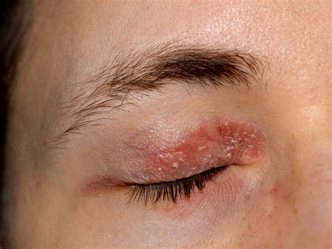 Atopic Keratoconjunctivitis - AKC - Ora LLC