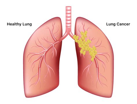 Warning Signs Of Lung Cancer