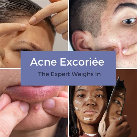 Patient Buzz: Acne Excoriée | The Expert Weighs In - Next Steps in Dermatology