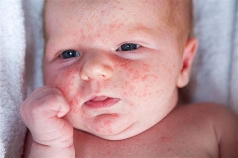 Understanding Common Newborn Rashes: A Paediatrician’s Guide for Parents