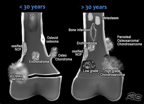 osteosclerotic bone tumors | Anatomie und physiologie, Anatomie, Physiologie
