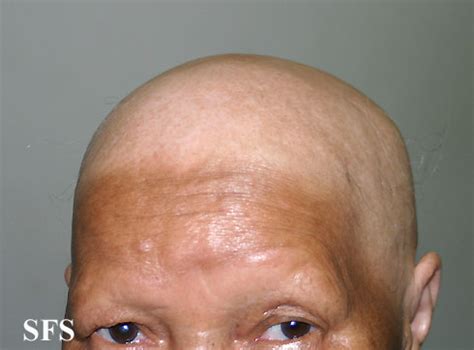 Alopecia areata - wikidoc