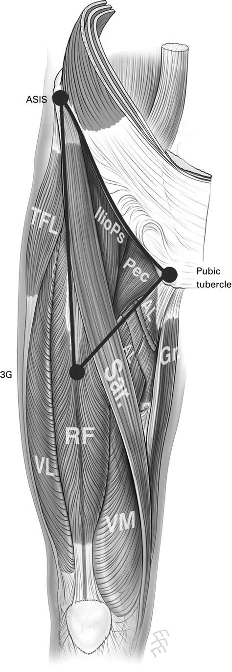 Chronic Groin Pain – Dr Bill Tran Laser Acupuncture