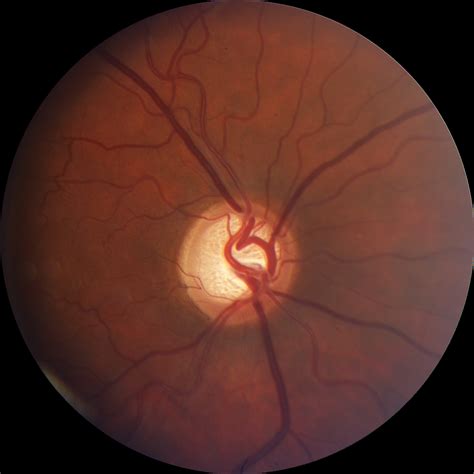 Photos Of Glaucoma Optic Nerve Cupping