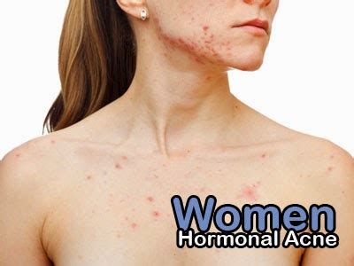 Hormonal Acne Women: Possible Hormonal Disorder | Hormonal Acne Tips