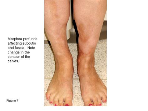 Linear Scleroderma