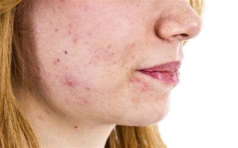 Scabs on Face Meaning, Symptoms, Causes and Getting Rid of Them Fast - American Celiac