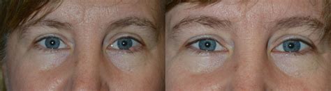 Beverly Hills eyelid-skin-cancer-surgery-and-eyelid-reconstruction | Taban MD oculoplastic ...