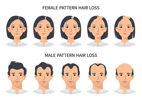 Hair loss stages, androgenetic alopecia male and female pattern. Steps of baldness vector ...