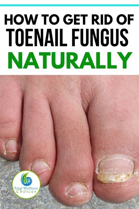 9 Best Natural Home Remedies for Toenail Fungus | Toenail fungus ...