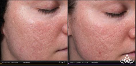 | Phoenix, AZAcne Scars Before & After Gallery