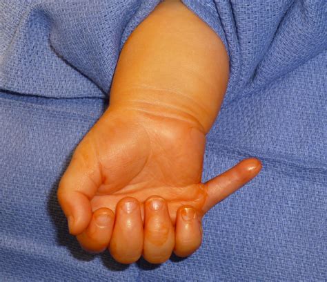 Extra Digits | Congenital Hand and Arm Differences | Washington University in St. Louis