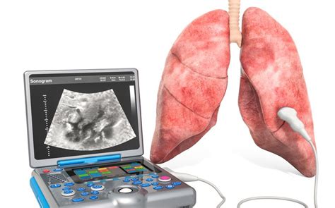 Lung ultrasound scan non-inferior to chest X-ray for COVID-19 pneumonia diagnosis - Hospital ...