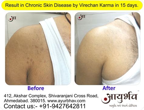 Best Panchakarma Result in Chronic Skin Disease – Ayurbhav | Ayurved ...