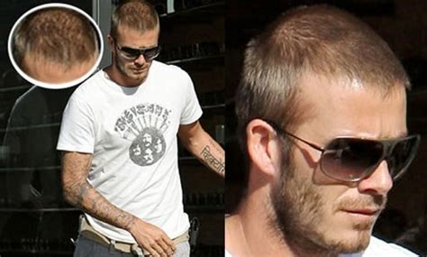 rsz_david_beckham_hair_loss - Celebrities hair transplants