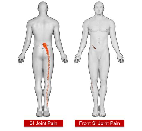 Sacroiliac Joint (SI Joint) Fusion - The Orthopaedic Center