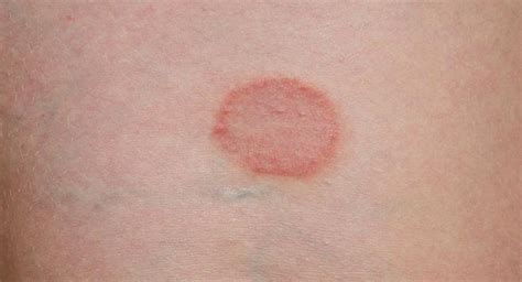 Ringworm Symptoms, Causes, Diagnosis and Treatment - Natural Health News