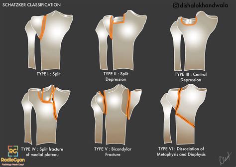 Schatzker Classification of Tibial Plateau Fractures in 2021 | Tibial ...