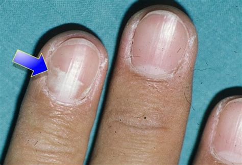 vertical black line on nail