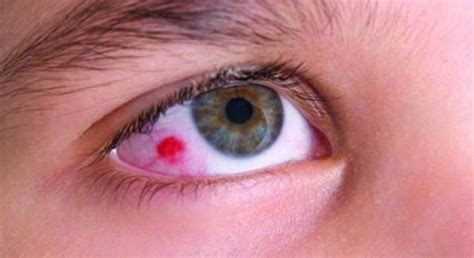 Eye Cancer - Symptoms, Causes, Diagnosis, Treatment, Prevention | HealthMD