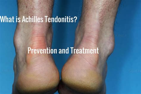 What Is Achilles Tendinitis? Prevention And Treatment - HubPages