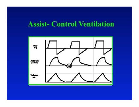 Optimizing Critical Care Ventilation: What can we learn from Ventilat…