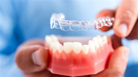 Benefits Of Invisalign Over Traditional Braces - CTN News