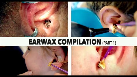 MASSIVE EARWAX REMOVAL COMPILATION (Part 1) | Dr. Paul - YouTube