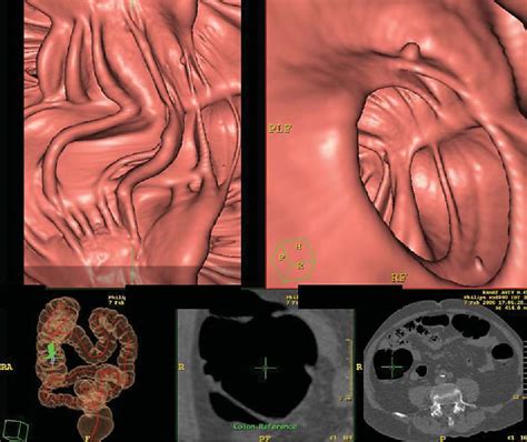 Figure 1 from CT Colonography (Virtual Colonoscopy): Technique, Indications and Performance ...