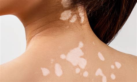 Columbus Skin Discoloration Treatment | Eastside Dermatology