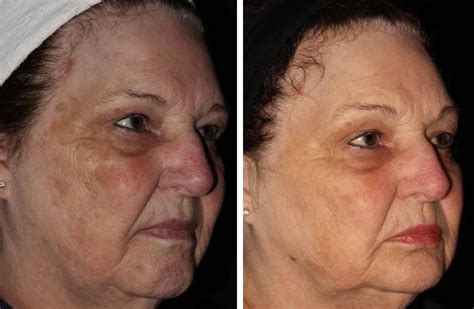 Treat Brown Spots and Melasma with PICO Genesis™ Laser | Salmon Creek ...