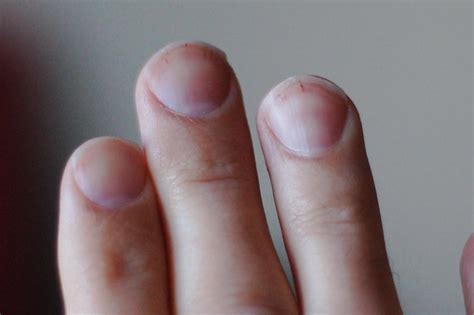 What Your Fingernails Can Reveal About the Risk of Lung Cancer - Huffington News