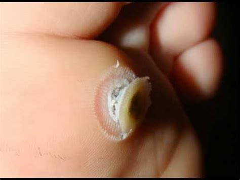 Plantar Wart Root Depth | Bruin Blog