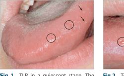 [PDF] Transient lingual papillitis ORAL MEDICINE | Semantic Scholar