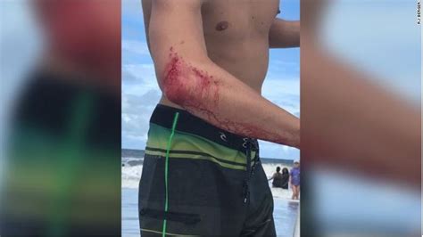 There were two shark attacks off the coast of Florida this weekend | WPEC