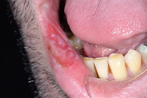 Oral syphilis – A case report - Scottish Dental magazine : Scottish Dental magazine