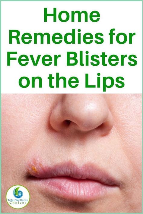 13 Natural Home Remedies for Fever Blisters on the Lips (With images) | Fever blister remedy ...
